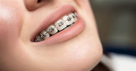 behel bracket metal dentaurum german|Braces .